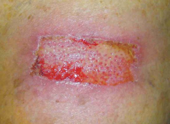 5 Reasons Wounds Won’t Heal – The Wound Guy