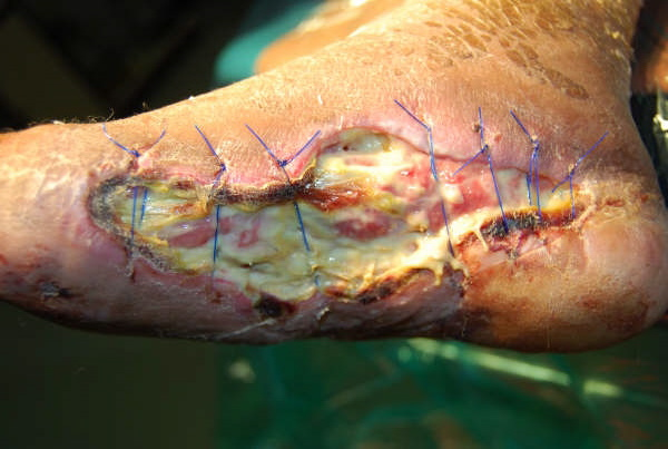 diabetic foot wound heal won wounds abscess reasons breast infections diabetes infection surgical surgery guy dehisced mastitis treatment victim articles