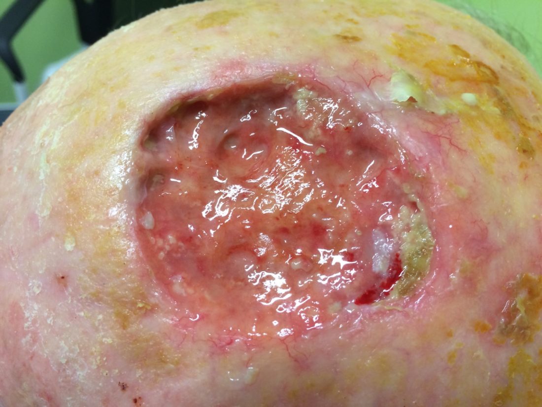 Bringing non-healing wounds into the open – The Wound Guy